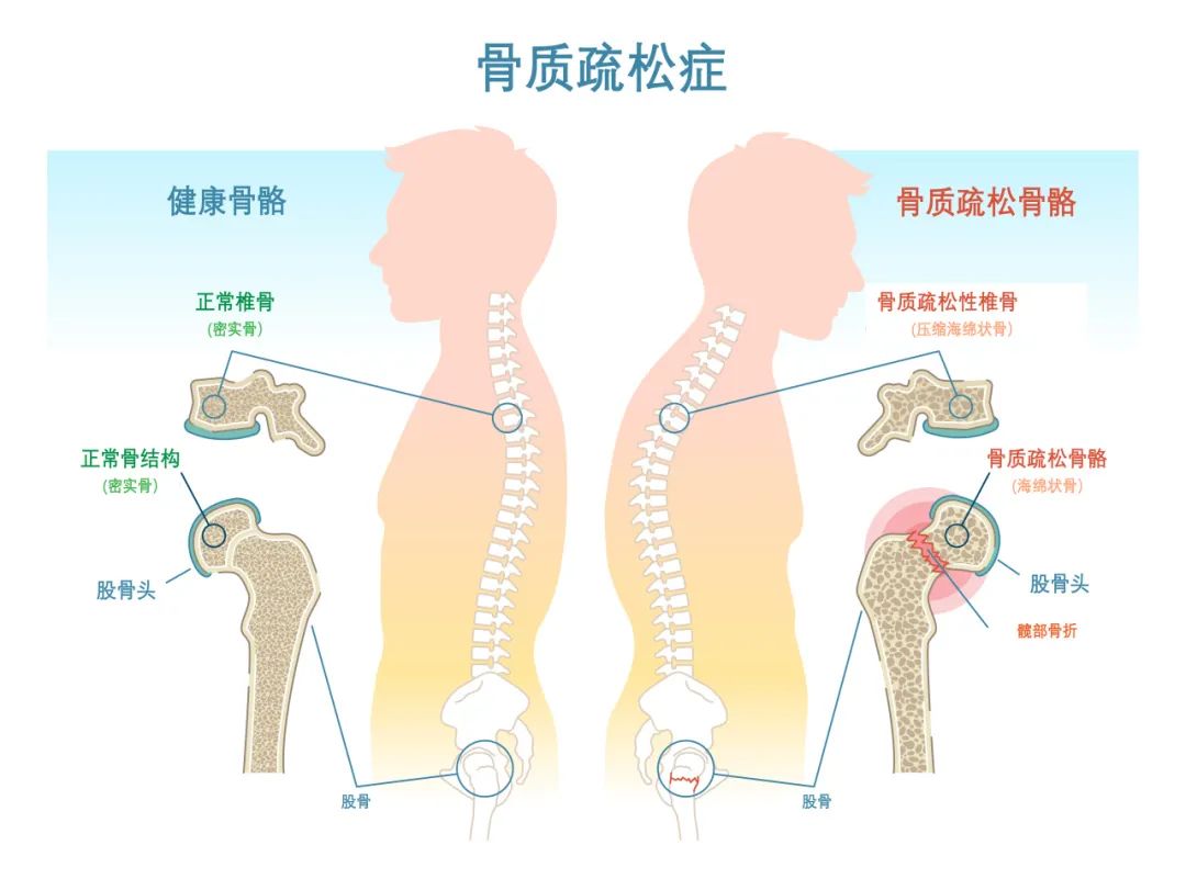 合肥京东方医院：骨质疏松可防可治