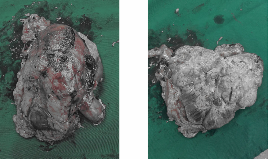 宁城县中心医院泌尿外科完成高难度腹腔镜肾癌根治术