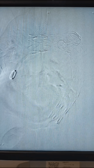 九枚支架,撑起生命通道!警惕大血管内的「不定时炸弹」