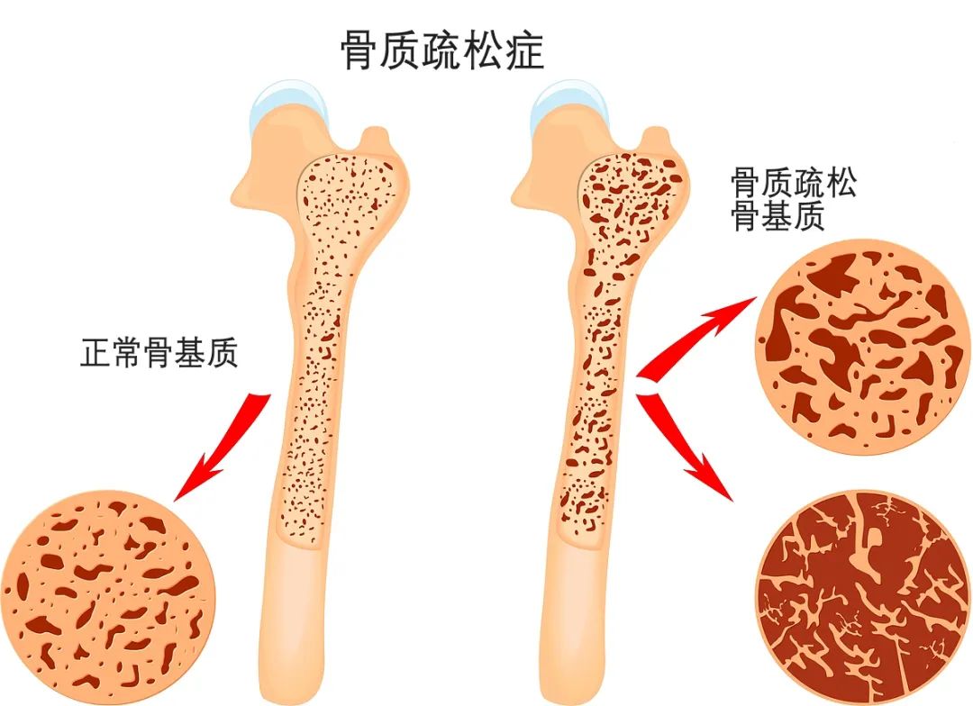 合肥京东方医院：骨质疏松可防可治