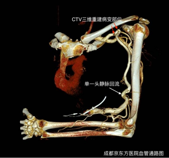 超声引导下 PTA 解除头静脉弓狭窄病变