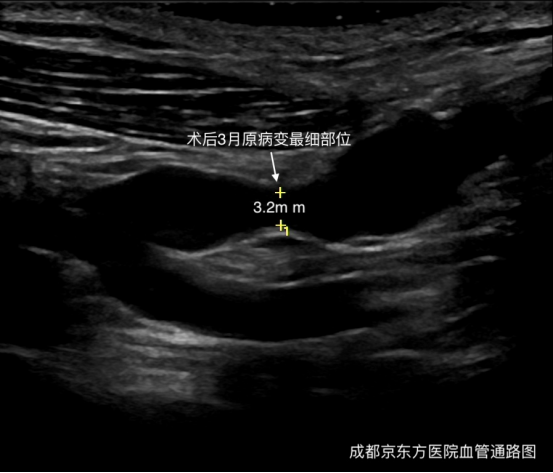 超声引导下 PTA 解除头静脉弓狭窄病变