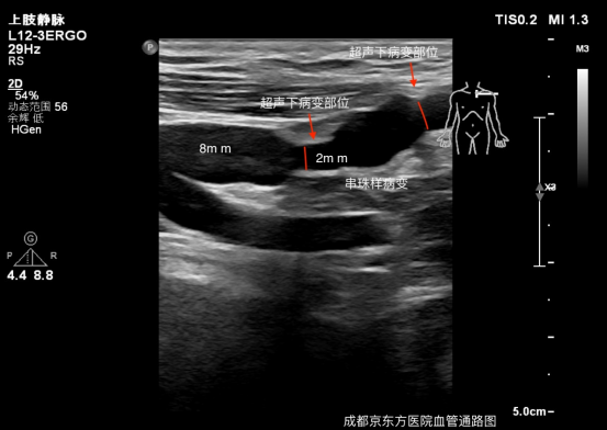 超声引导下 PTA 解除头静脉弓狭窄病变