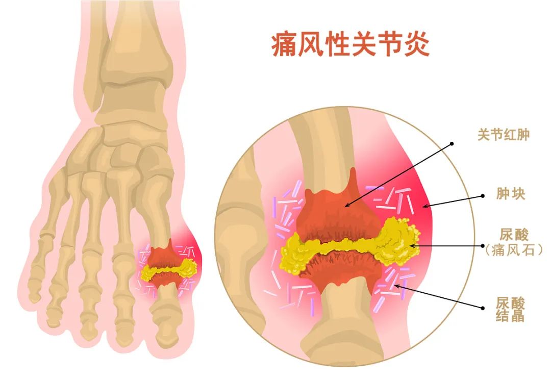 合肥京东方医院：年轻人「尿酸」超高，需警惕！