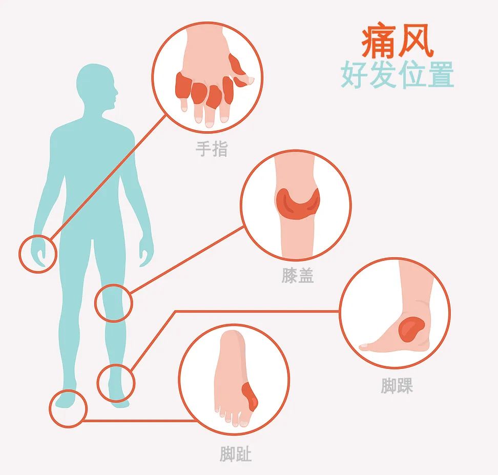 合肥京东方医院：年轻人「尿酸」超高，需警惕！
