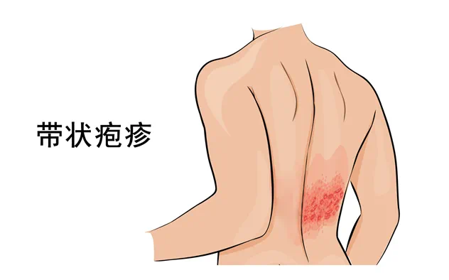合肥京东方医院科普：带状疱疹-水痘病毒一旦感染，终身携带！1 个方法提前预防
