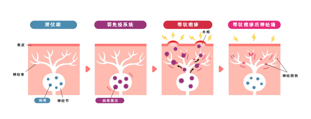 合肥京东方医院科普：带状疱疹-水痘病毒一旦感染，终身携带！1 个方法提前预防