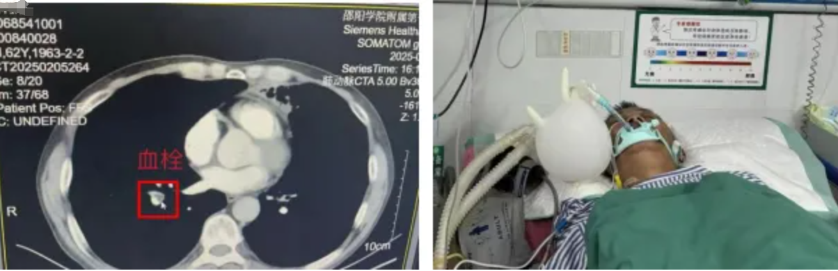 警惕肺栓塞,别让「沉默杀手」堵住你的肺!