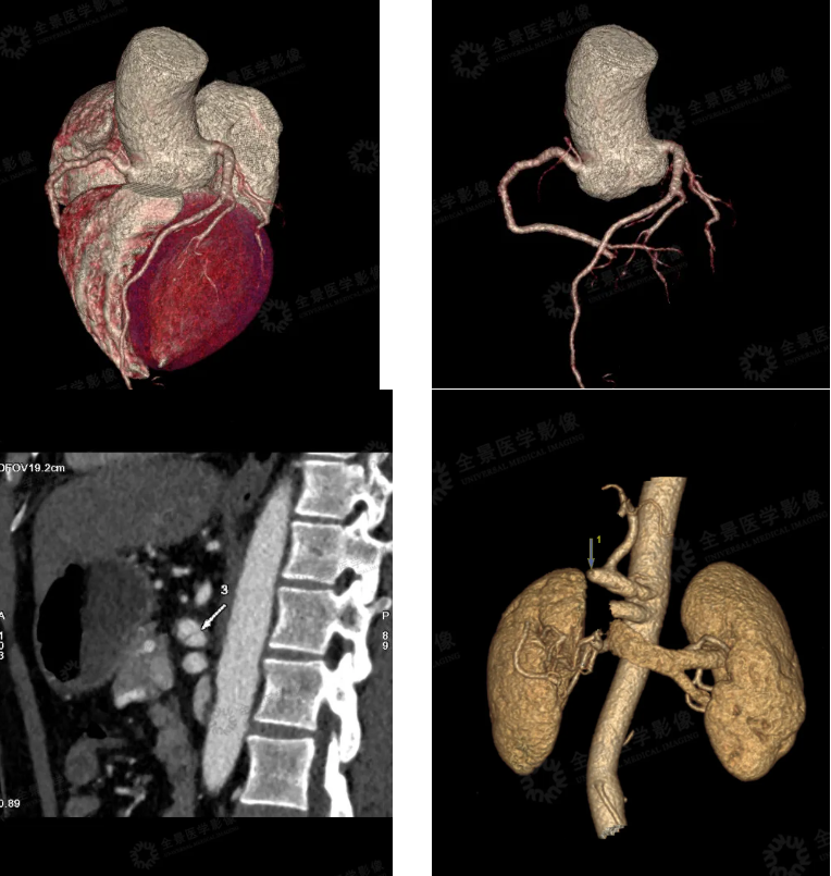 全景医学深度体检揪出 「真凶」 腹主动脉瘤