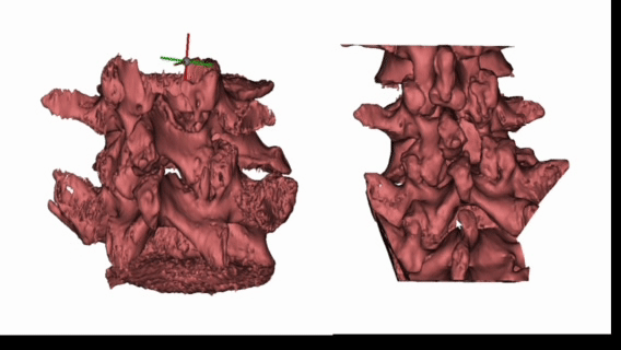 陕北首例!延大附院脊柱外科成功开展计算机导航联合 UBE 内镜可视化微创术