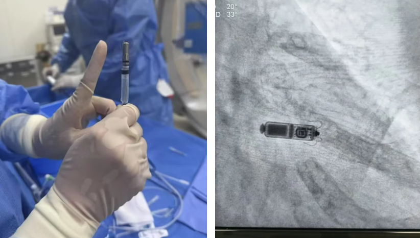 从 「大创伤」 到 「微植入」：北大医疗鲁中医院心脏起搏新突破