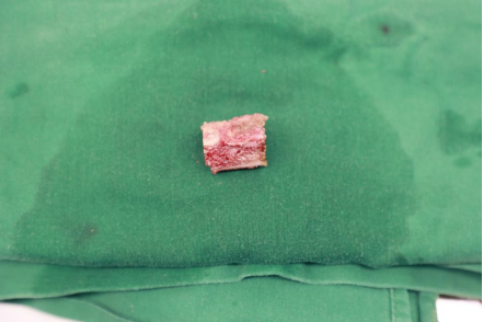 只因日日酒相伴  「七尺男子汉」差点喝「塌」股骨头