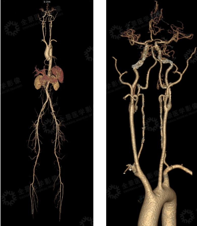 全景医学深度体检揪出 「真凶」 腹主动脉瘤