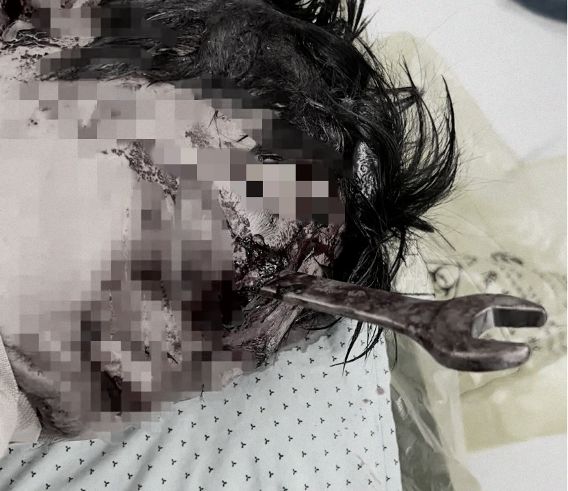 扳手插入颅内命悬一线!湖州市中心医院成功抢救