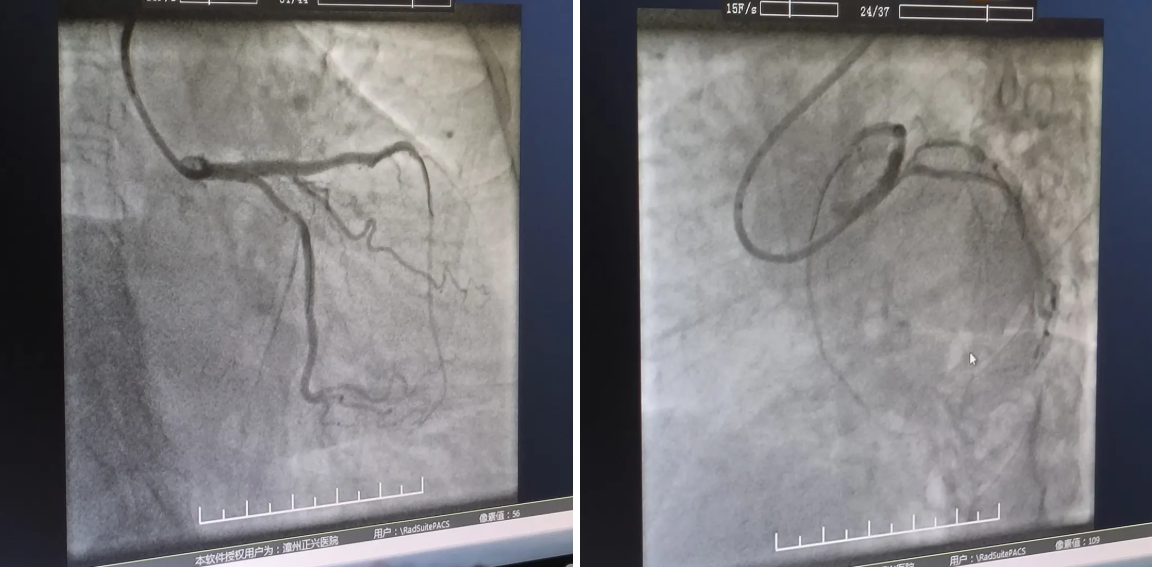 女子因流感入院,却查到一处又「窄」了!