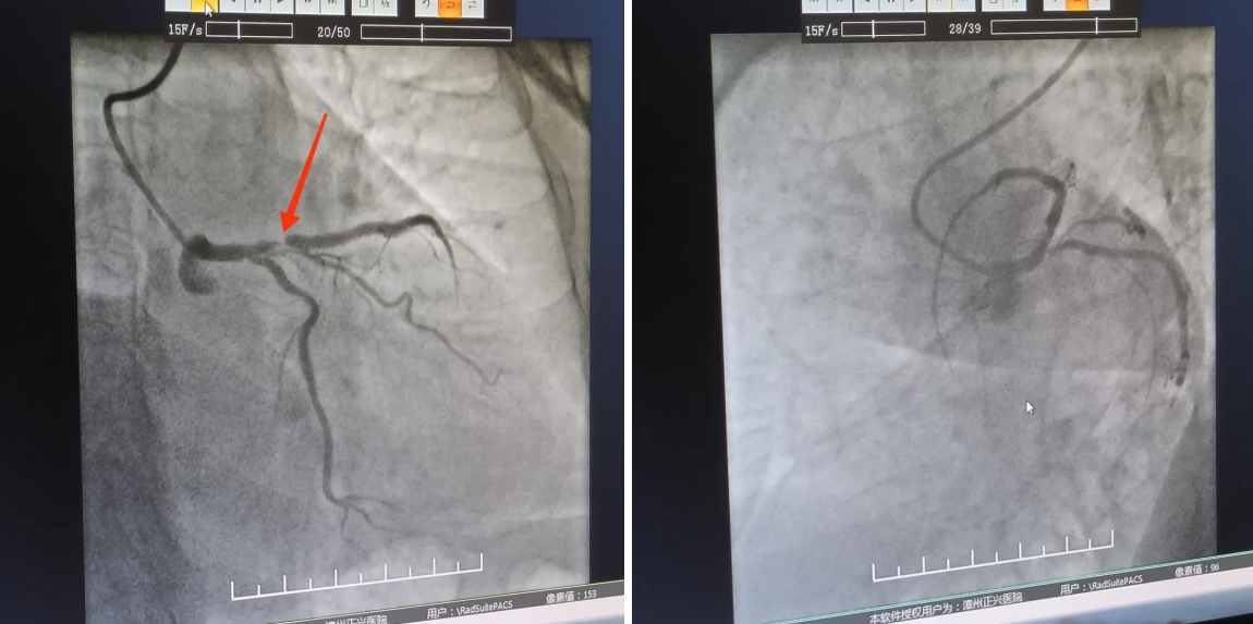 女子因流感入院,却查到一处又「窄」了!