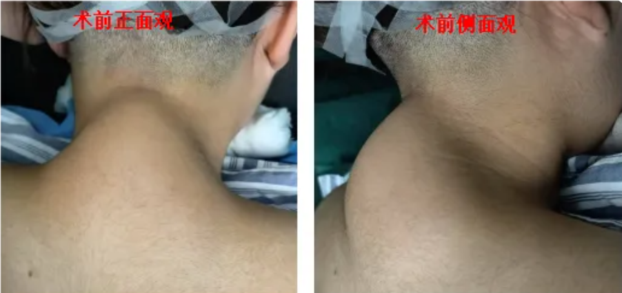 邵阳学院附属第一医院耳鼻咽喉头颈外科成功实施隐蔽切口内镜手术