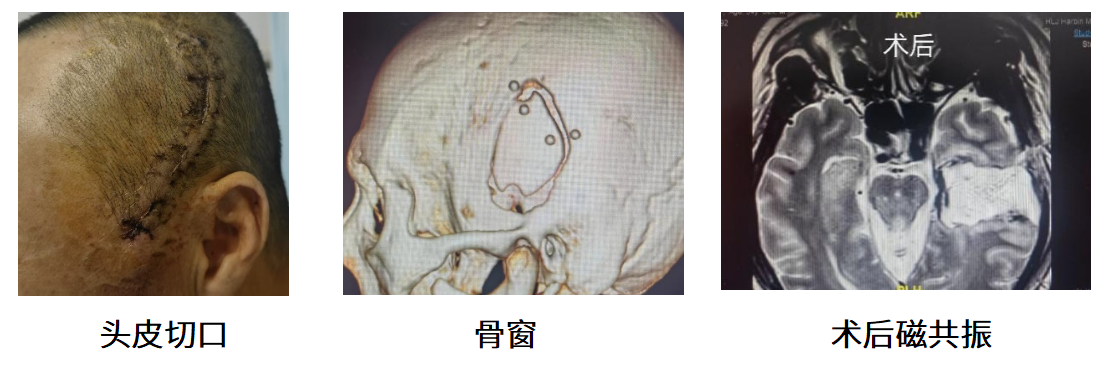 「小骨窗」让患者「重控」人生 哈医大一院神外四病房直击病灶微创治疗颞叶癫痫