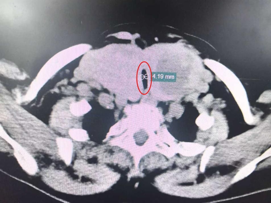 巨大甲状腺肿压迫气道险窒息! 武大人民医院 MDT 团队妙解七旬老人痛楚