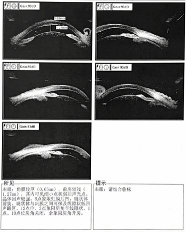 西安交大二附院眼科开展陕西省首例微创小梁切除术 (SIGS)