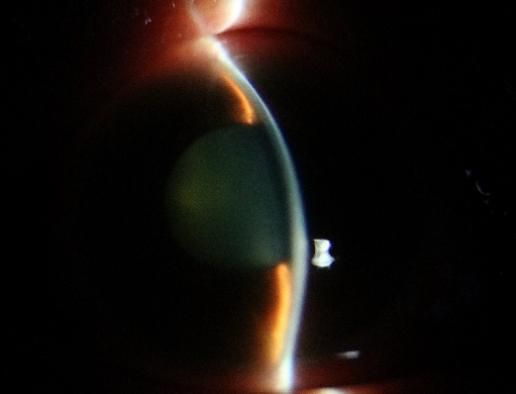 西安交大二附院眼科开展陕西省首例微创小梁切除术 (SIGS)