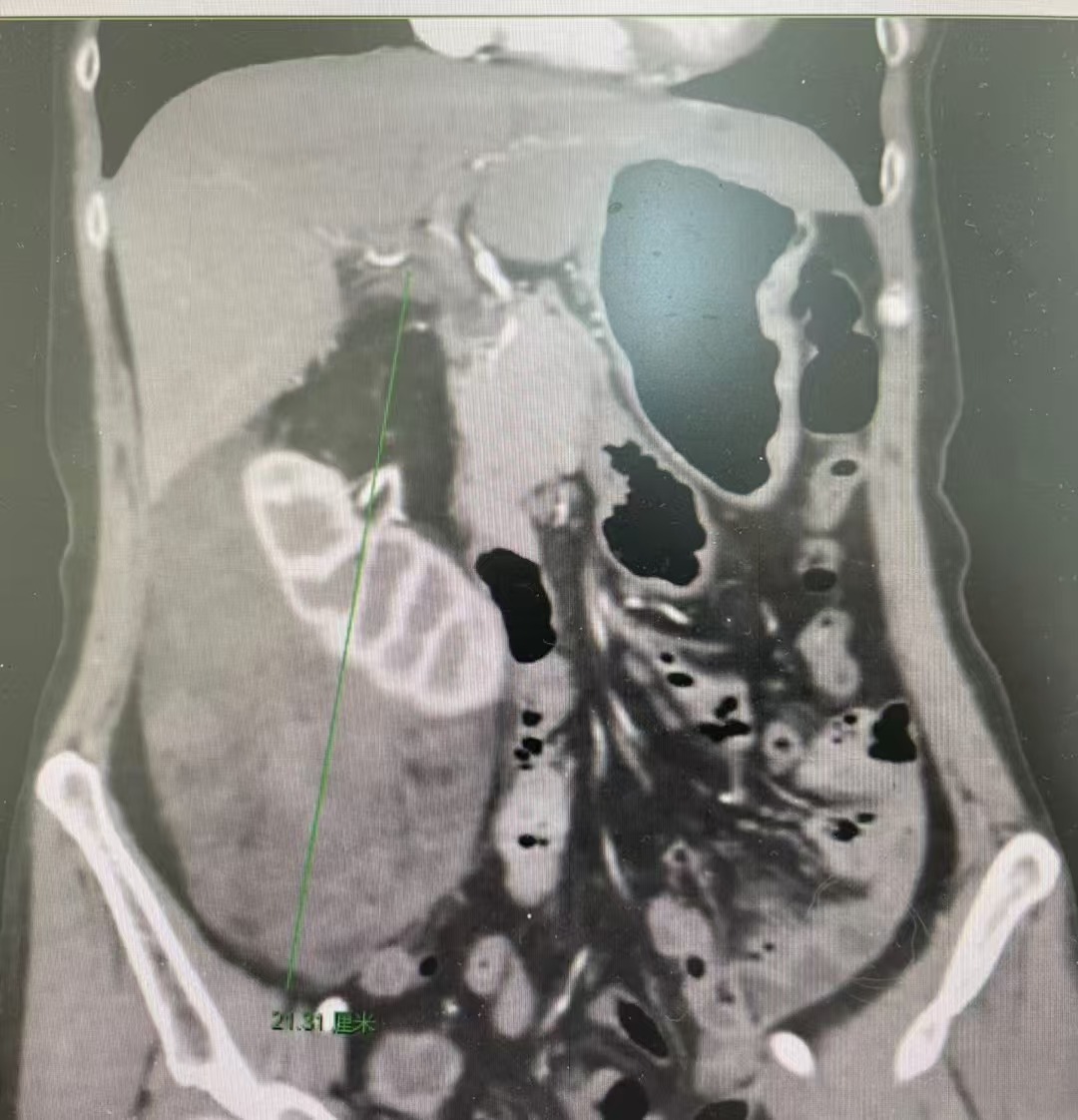 挑战「手术雷区」！南昌大学二附院成功完成一例巨大肾肿瘤「切瘤保肾」术