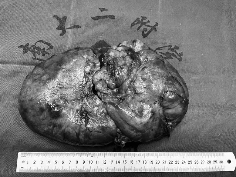 挑战「手术雷区」！南昌大学二附院成功完成一例巨大肾肿瘤「切瘤保肾」术