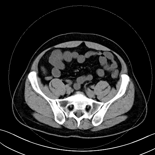 阑尾镜解锁腹痛谜题:一例非典型阑尾病变的"隐形杀手"现形记