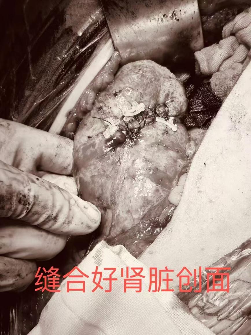 挑战「手术雷区」！南昌大学二附院成功完成一例巨大肾肿瘤「切瘤保肾」术