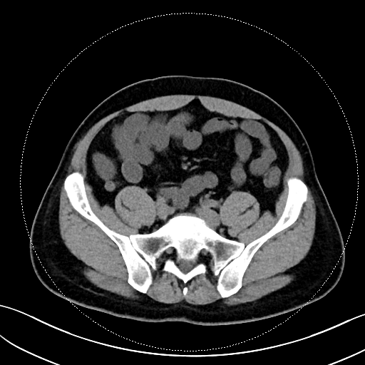 阑尾镜解锁腹痛谜题:一例非典型阑尾病变的"隐形杀手"现形记