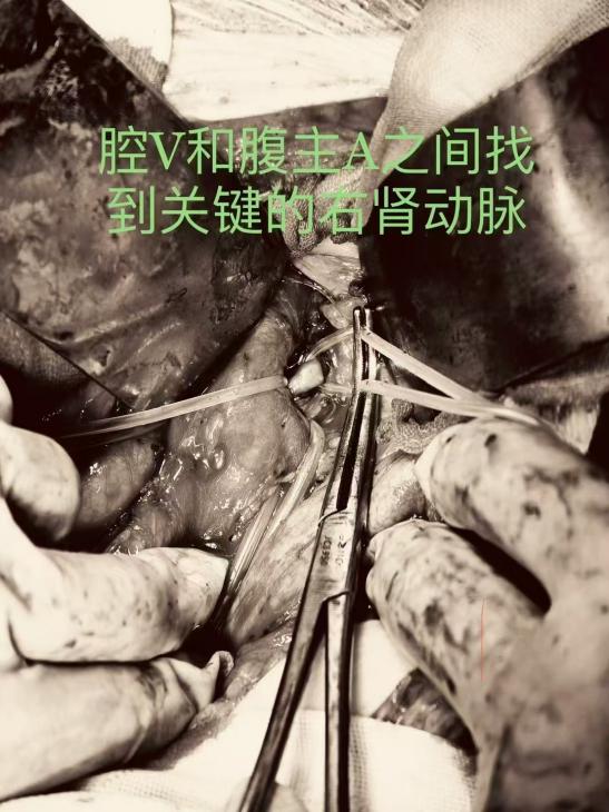 挑战「手术雷区」！南昌大学二附院成功完成一例巨大肾肿瘤「切瘤保肾」术