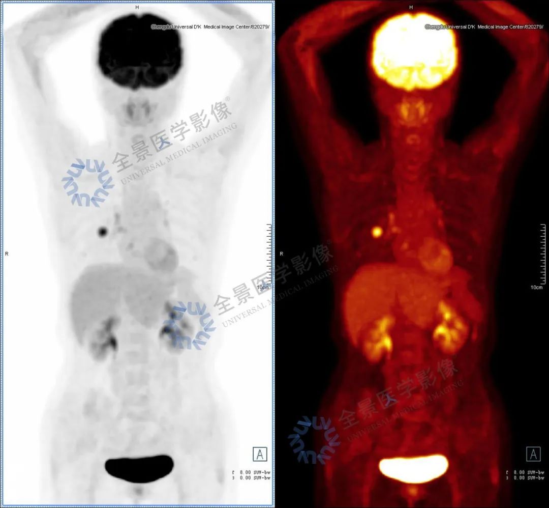 胸背部疼痛，PET/CT 发现肺癌