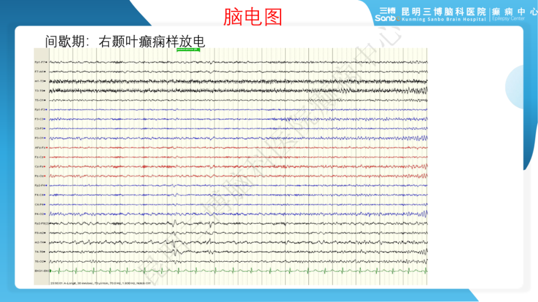 《「痫停」信步》第一期-手术治疗伴海马硬化颞叶内侧癫痫 1 例