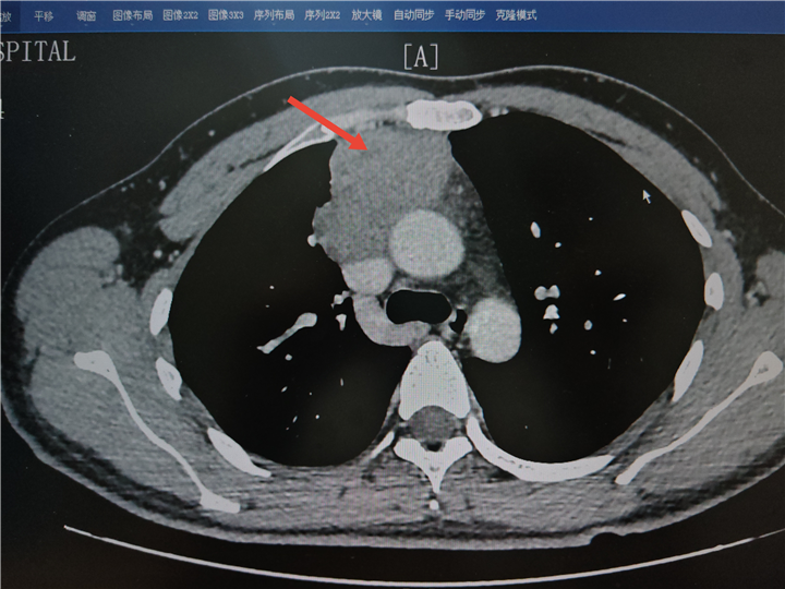 突破技术禁区!安徽省胸科医院开展自体心包补片联合人工血管置换术成功救治纵隔肿瘤患者