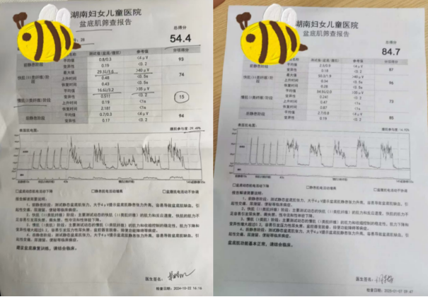 忍无可忍无需再忍,跟脱垂说拜拜!