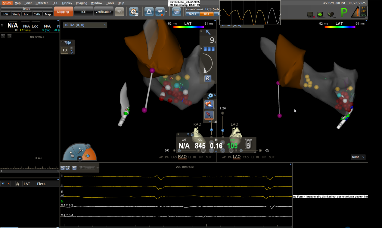 生死时速显担当 精准消融创奇迹 ——安徽省胸科医院心内科成功救治无休止室性心动过速患者