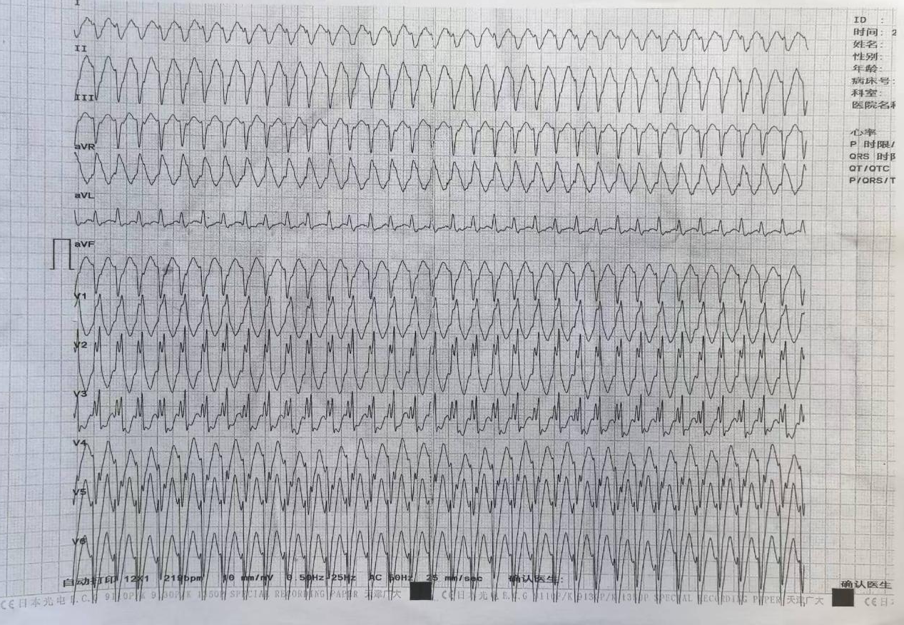 生死时速显担当 精准消融创奇迹 ——安徽省胸科医院心内科成功救治无休止室性心动过速患者
