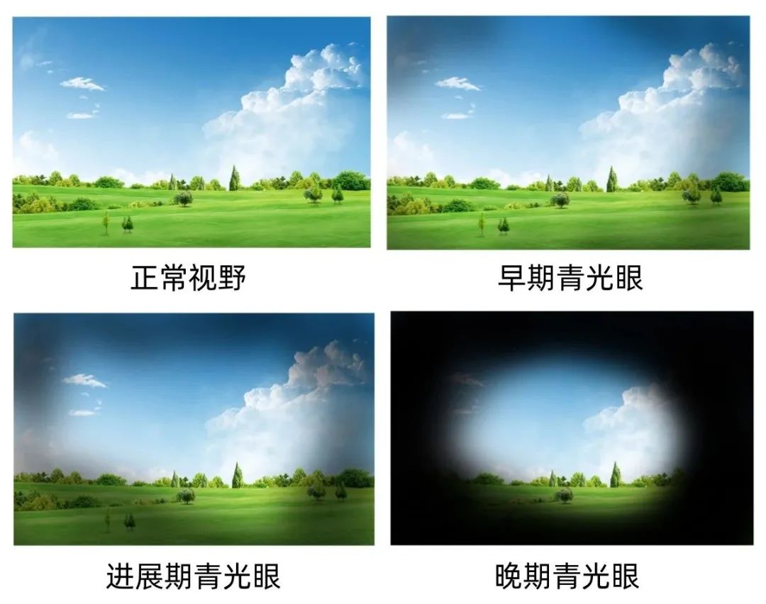 世界青光眼周 | 四个坏习惯正在喂养青光眼，这些习惯比熬夜更伤眼