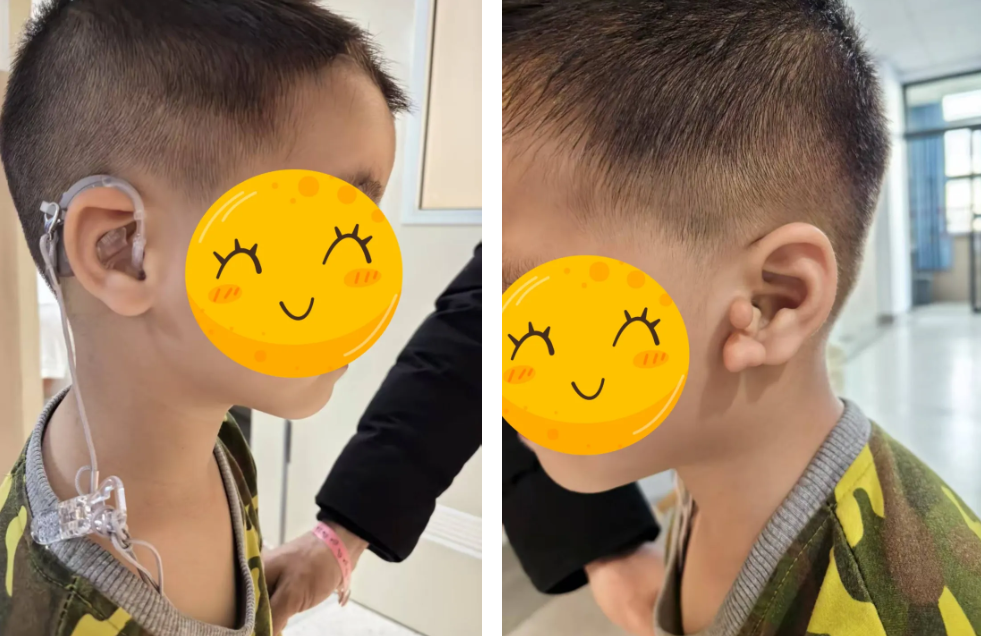 号外！深圳市妇幼保健院顺利完成院内首例享受集采政策的耳蜗手术