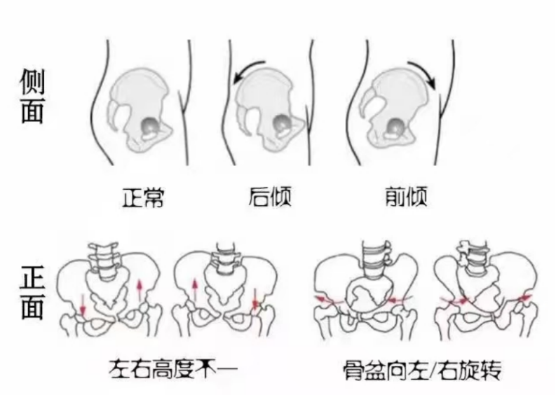 产后腰背痛？别让骨盆歪斜和阴道前壁脱垂拖垮新手妈妈
