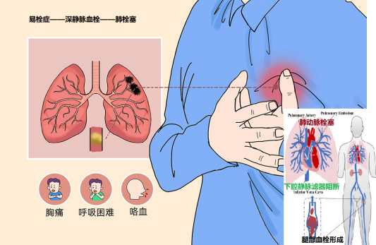 生死时速|潜江市中心医院多学科联动击退「肺动脉栓塞」