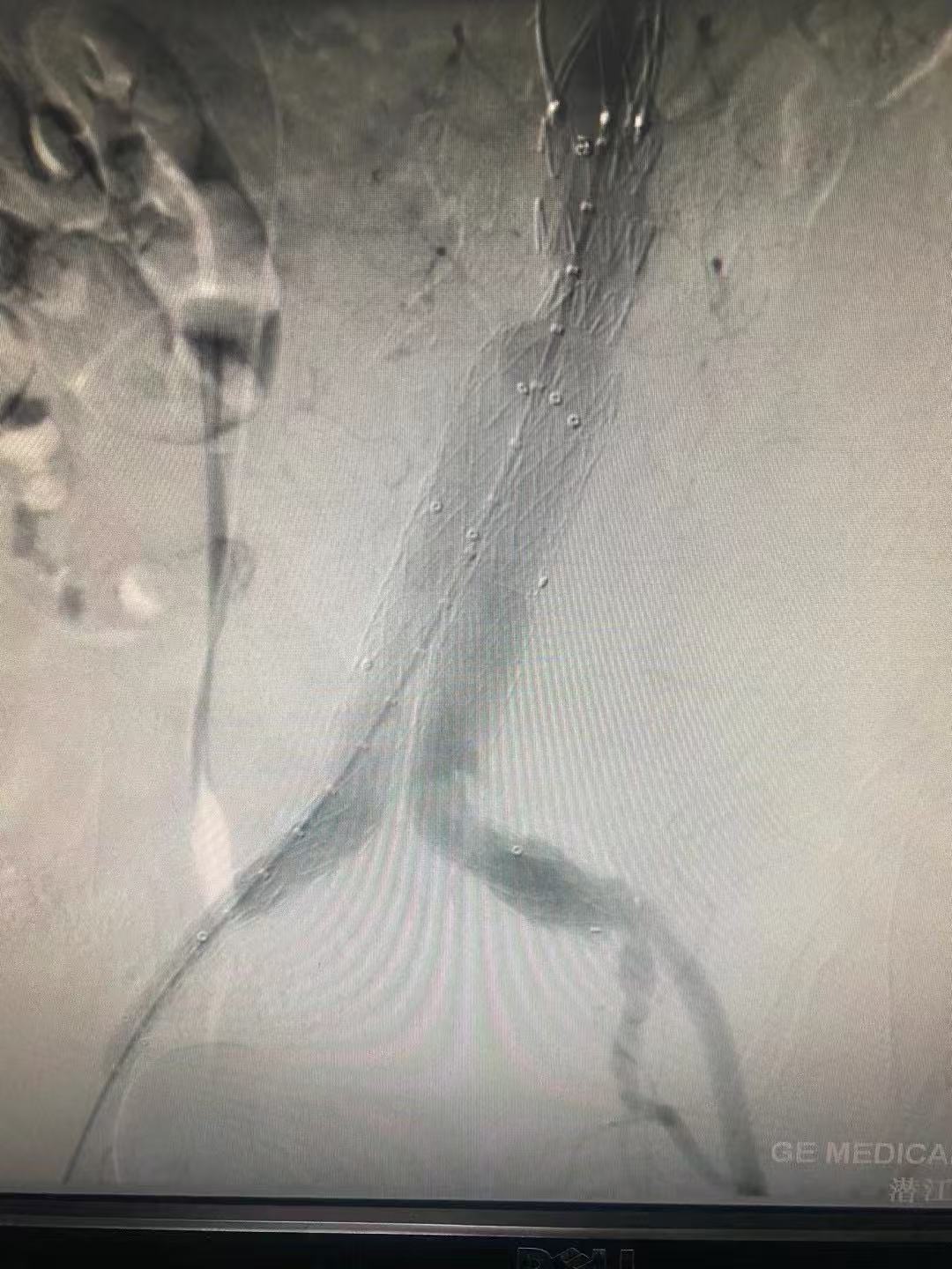 临危救险!微创介入治疗腹中精准「拆弹」