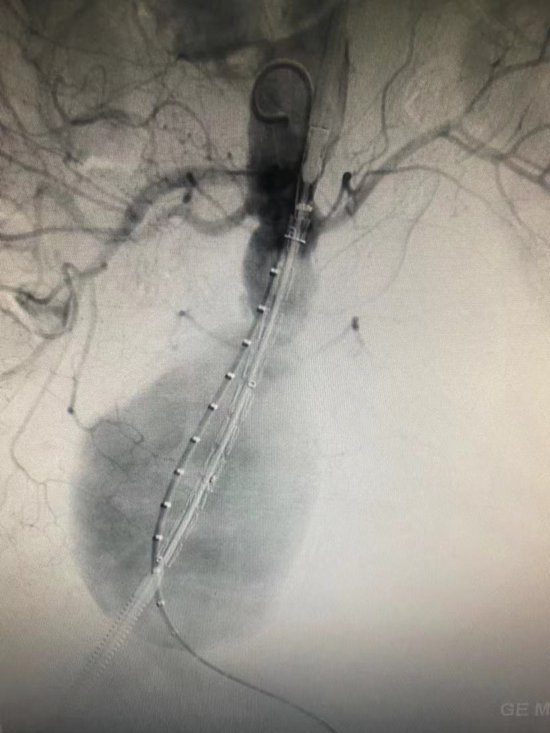 临危救险!微创介入治疗腹中精准「拆弹」