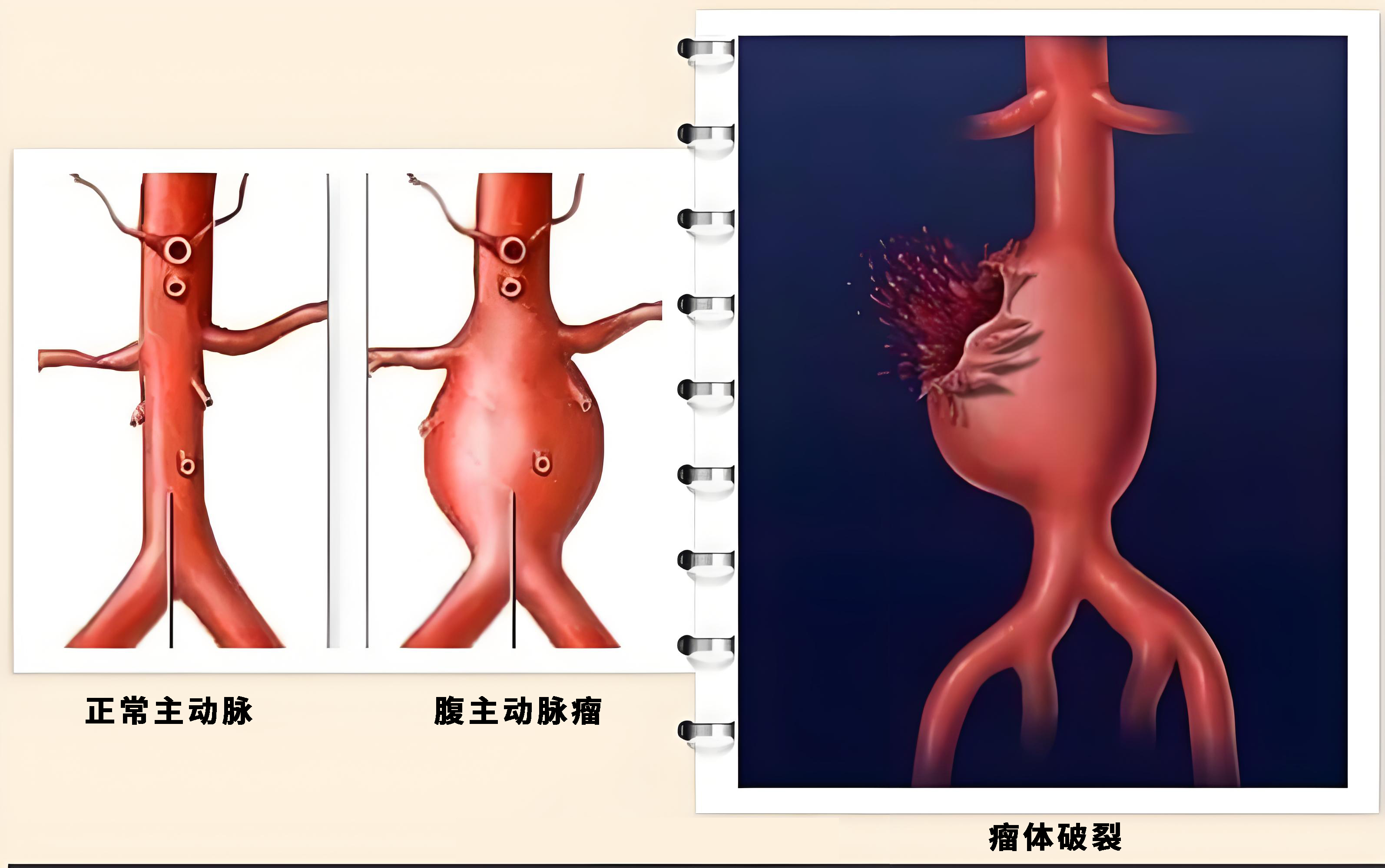 临危救险!微创介入治疗腹中精准「拆弹」