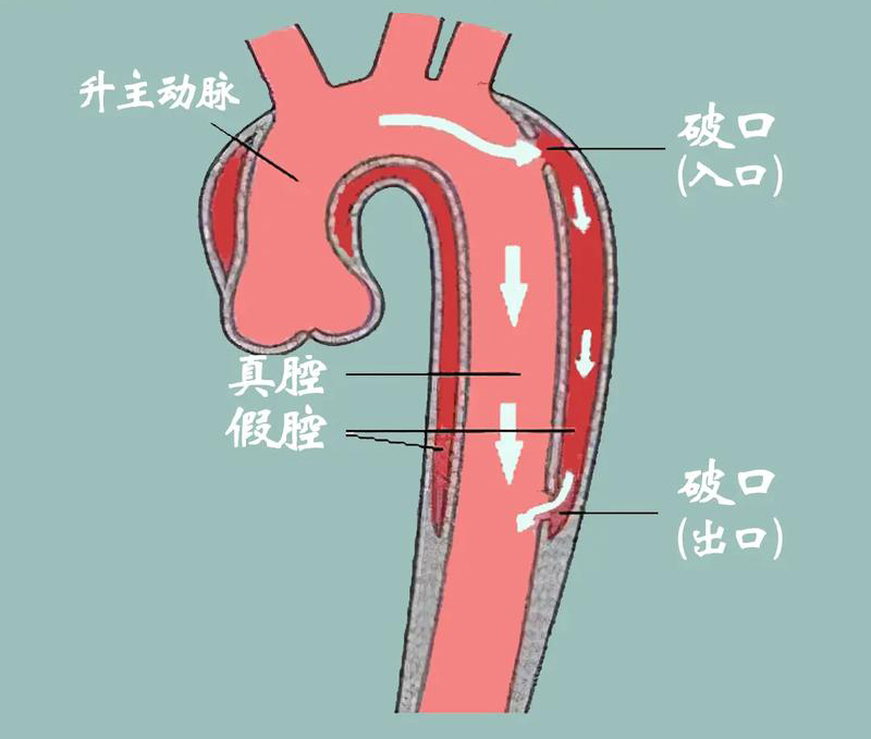 临危救险!微创介入治疗腹中精准「拆弹」
