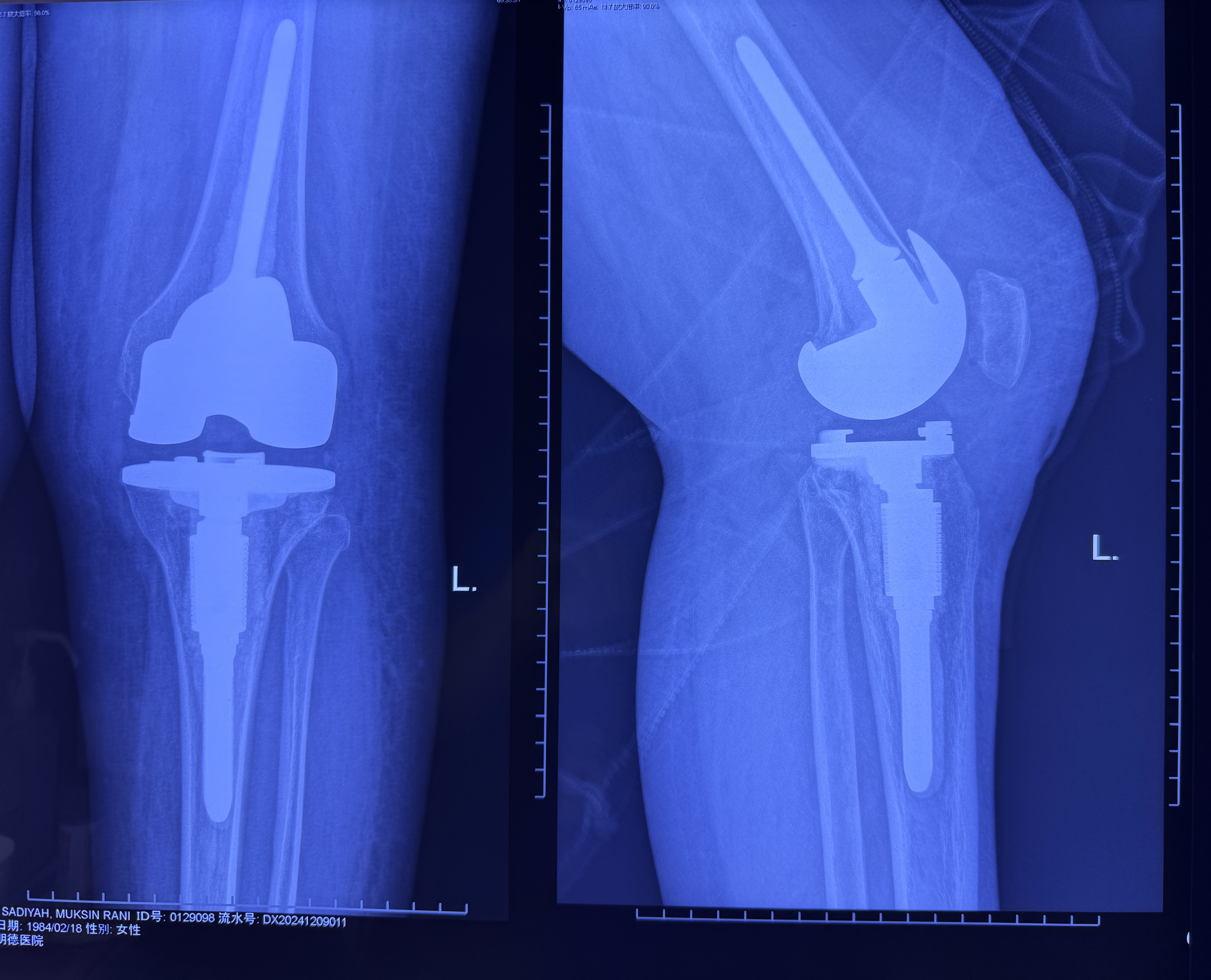 青年患者终末期色素沉着绒毛结节性滑膜炎(PVNS)的保膝治疗困境与关节置换考量