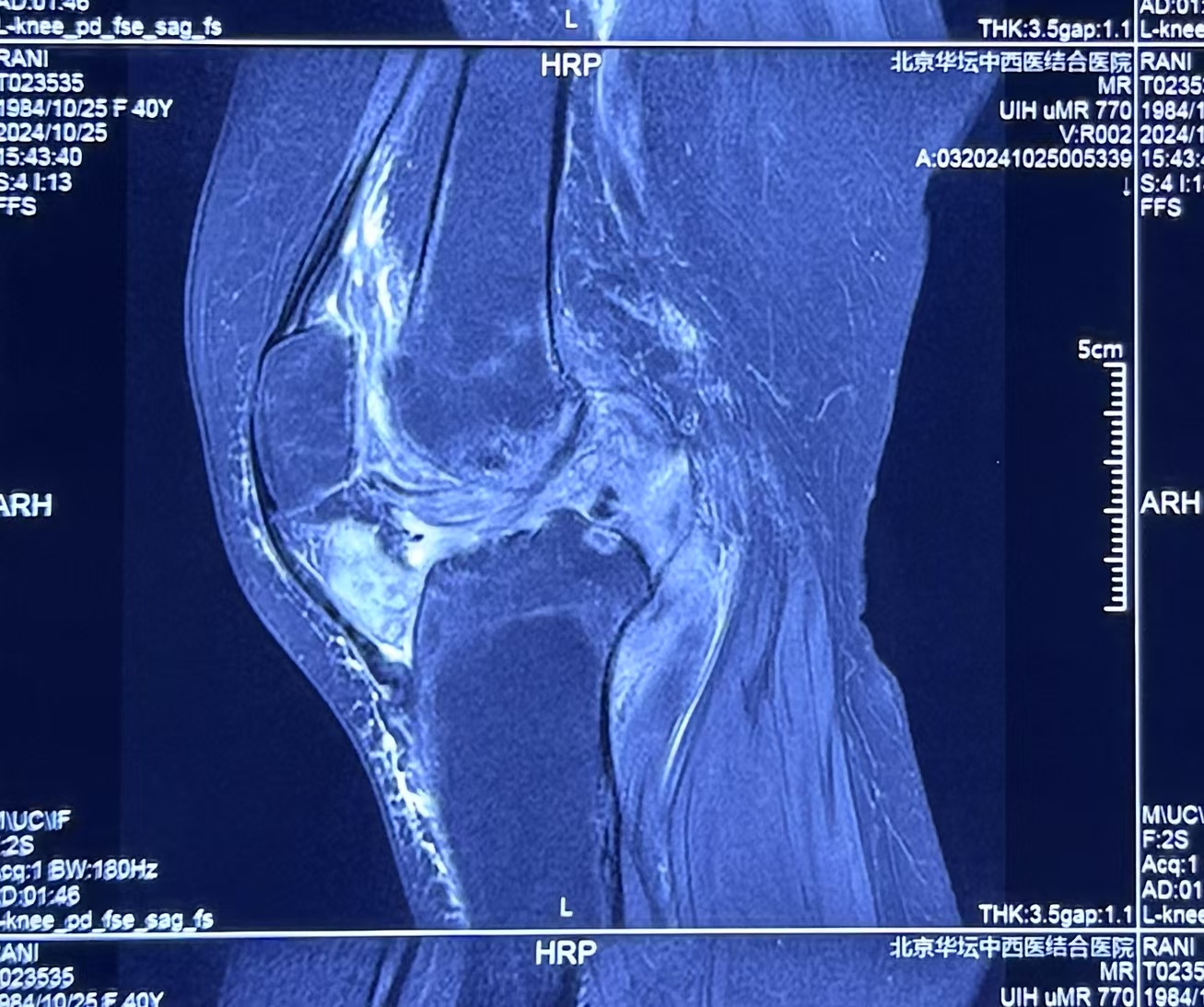 青年患者终末期色素沉着绒毛结节性滑膜炎(PVNS)的保膝治疗困境与关节置换考量