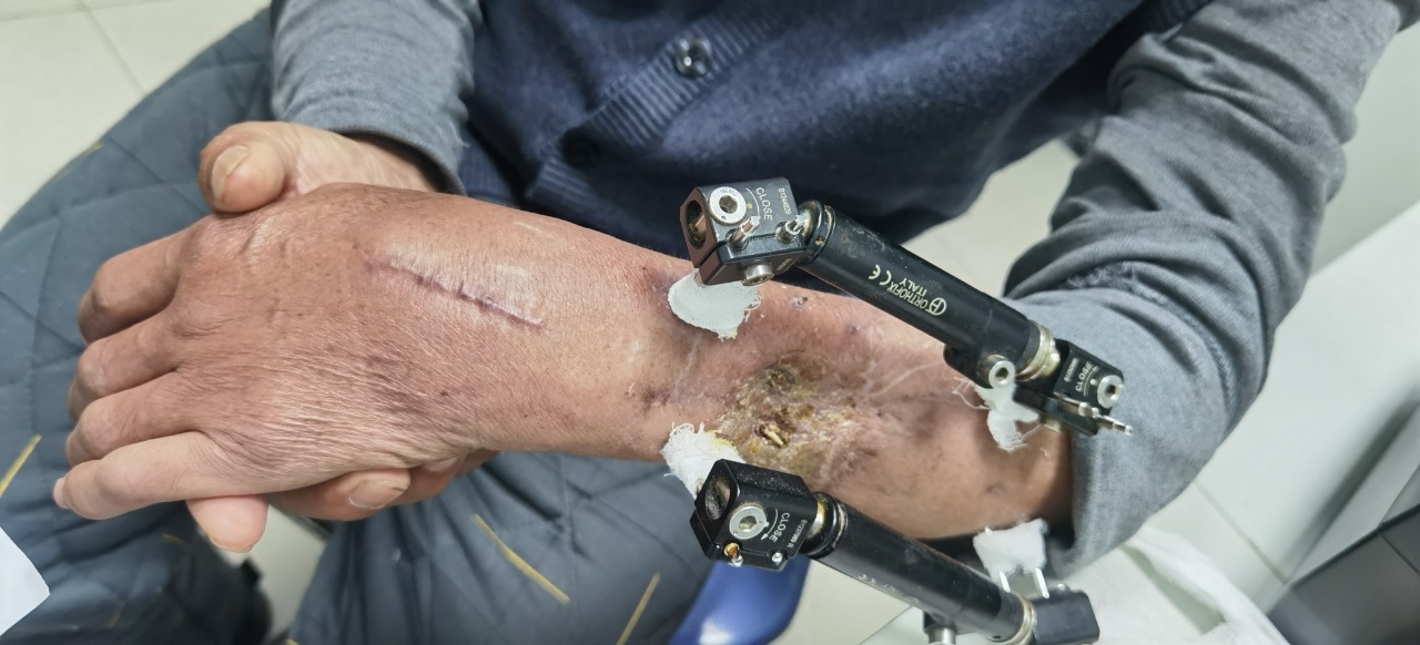 壮劳力手臂骨折不愈工作难,骨科专家复合杂交手术来「救场」