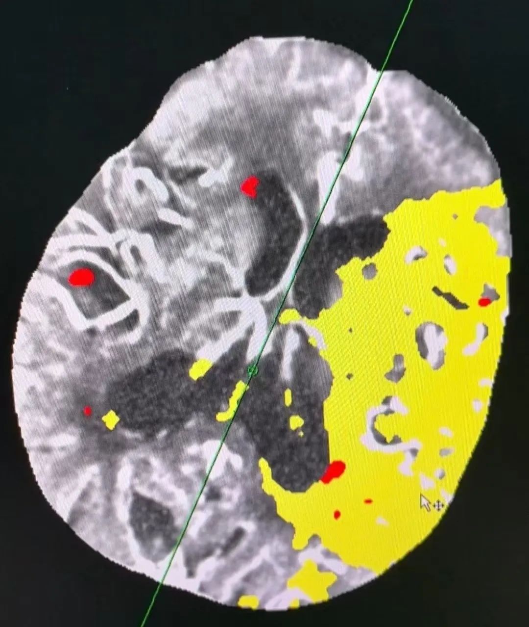 九枚血栓盘踞百岁之躯，命悬一线！漳州第三医院卒中中心力挽狂澜铸奇迹