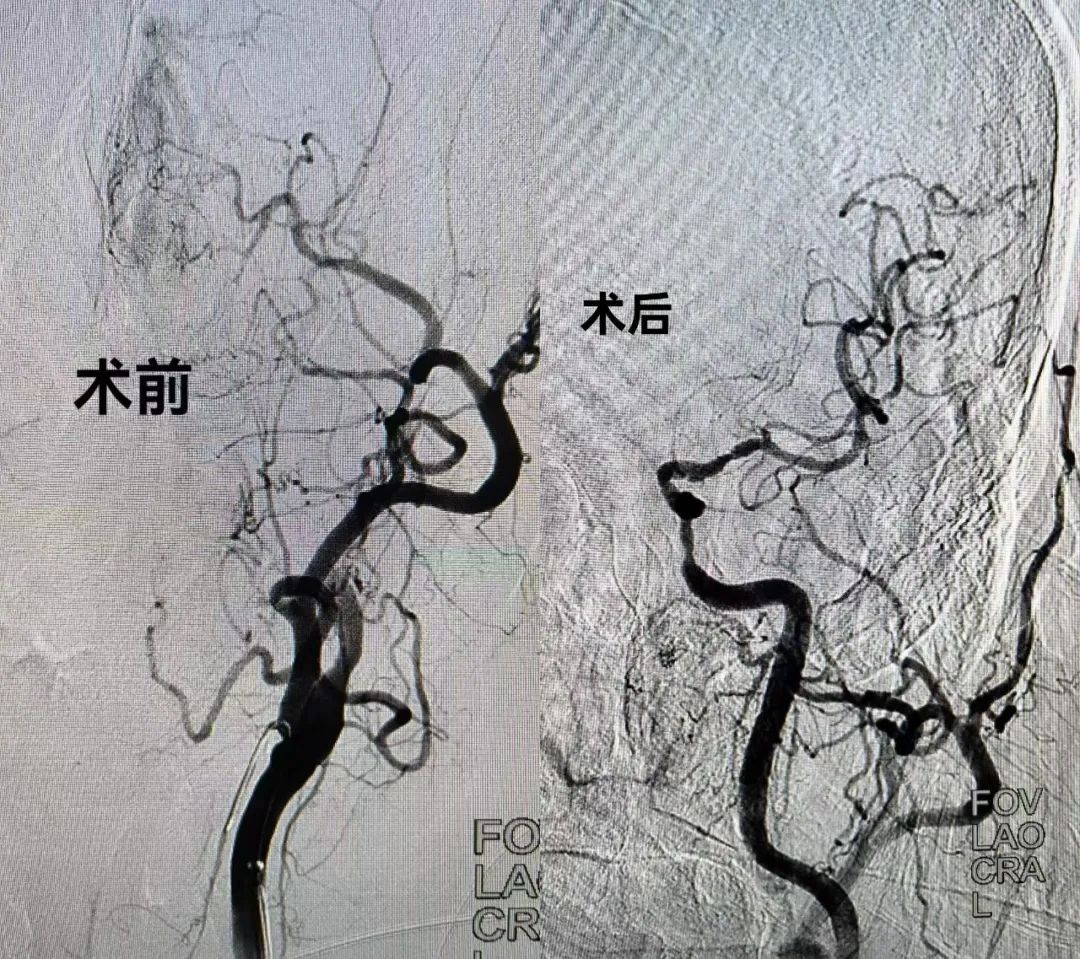 九枚血栓盘踞百岁之躯，命悬一线！漳州第三医院卒中中心力挽狂澜铸奇迹